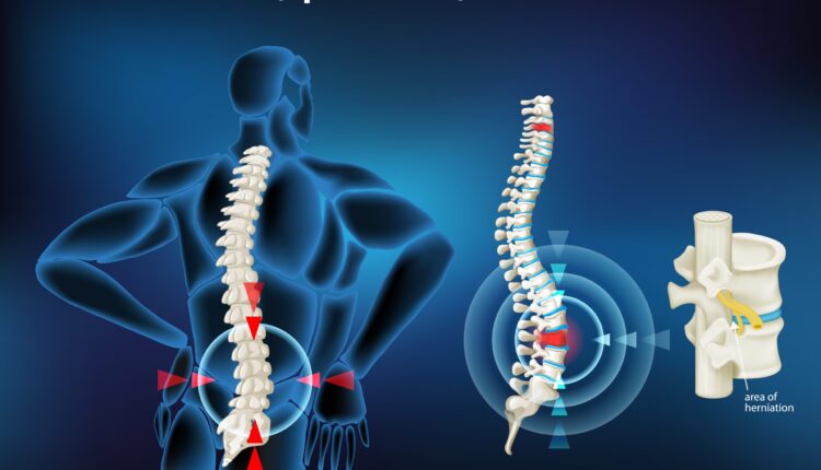 آناتومی دیسک کمر