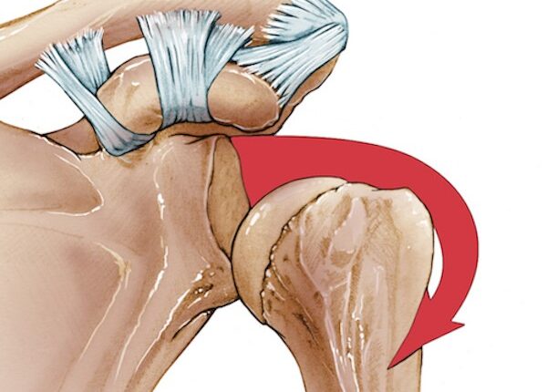 ناپایداری مفصل شانه - دکتر حسن براتی