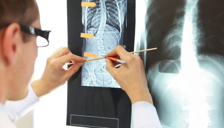 تشخیص انحراف ستون فقرات