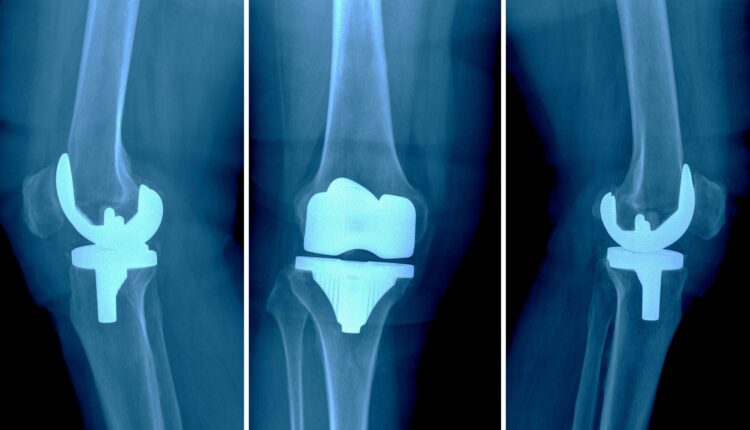 آرتروپلاستی زانو