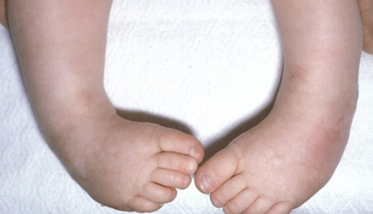 علت دفورمیتی مادرزادی