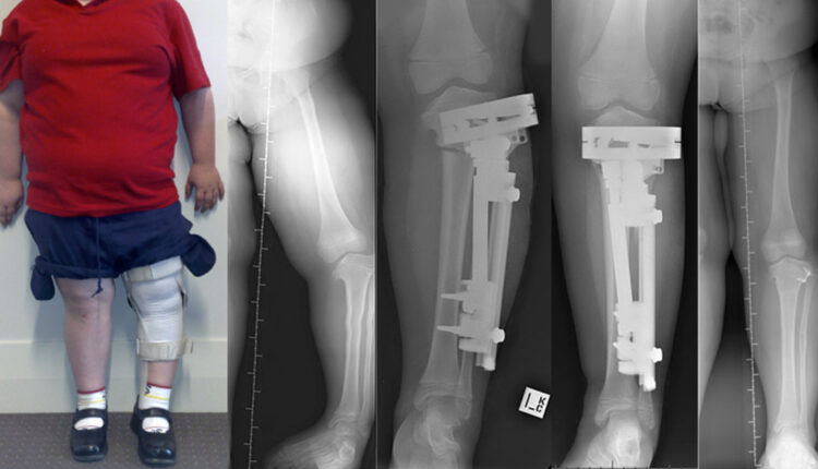 درمان دفورمیتی مادرزادی