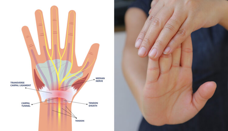 سندروم تونل کارپال