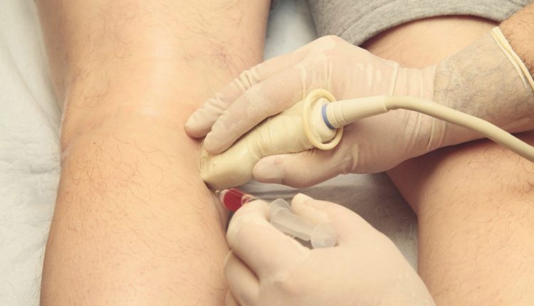 روند نزریق سلول بنیادی به زانو