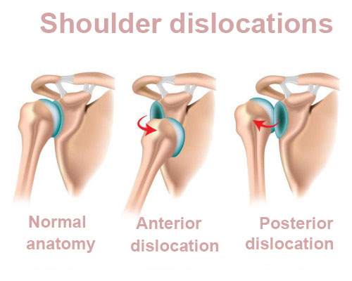 علائم و نشانه‌های دررفتگی مکرر شانه