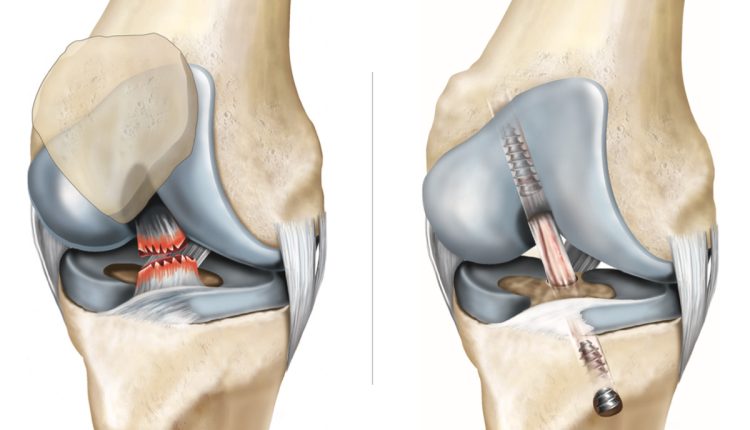 آناتومی رباط صلیبی قدامی