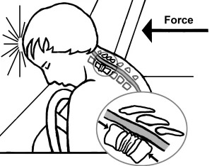 شکستگی مهره ها ستون فقرات