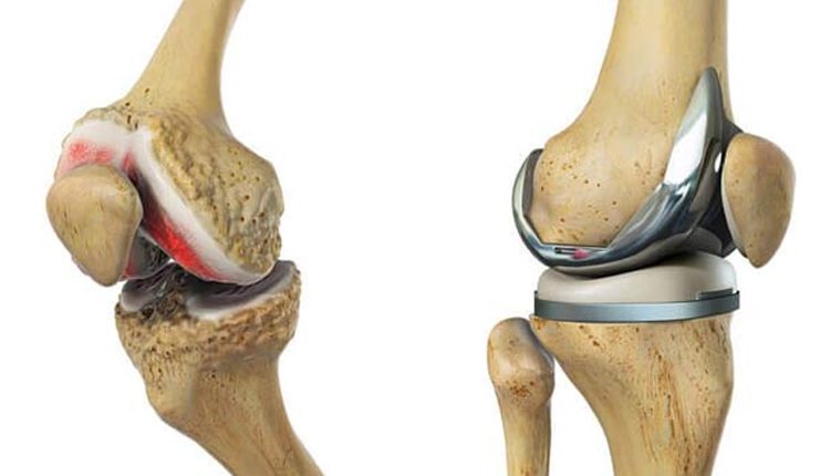 رایج ترین دلایل آسیب زانو