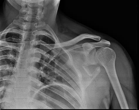 روش های تشخیص شکستگی کتف