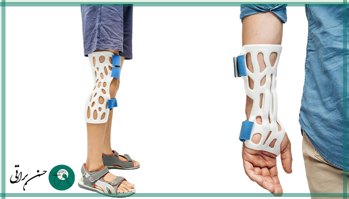 لزوم مراجعه به پزشک ارتوپد با تجربه برای گچ گرفتن و آتل بستن