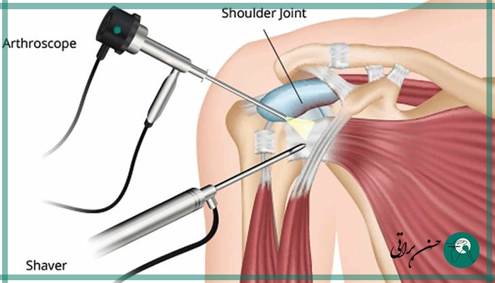 کاربردهای درمانی آرتروسکوپی شانه