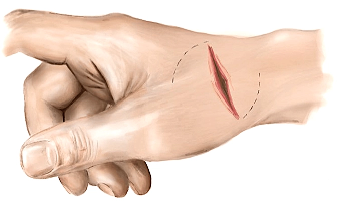 عمل چسبندگی عصب دست - دکتر حسن براتی