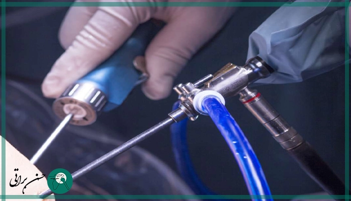 قبل از آرتروسکوپی زانو